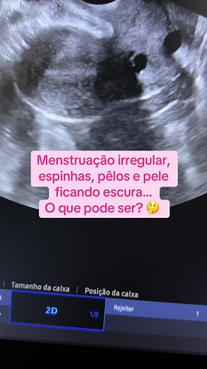 Ultrassom Pélvico e a Síndrome dos Ovários Policísticos