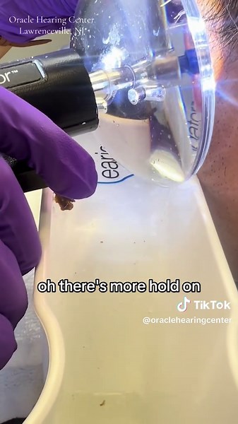 Ear Wax Removal Procedure Restores Hearing