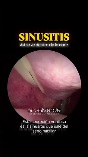 Así se ve una SINUSITIS por dentro 🤯 | Endoscopía nasal r