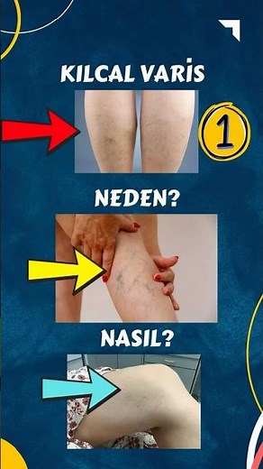 Varicose Veins: Causes, Everything You Need to Know, Serdar Akgün, Health Videos