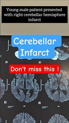 Cerebellar infarct can be disastrous if you miss this #stroke #neuro #hydrocephalus #neurosurgery