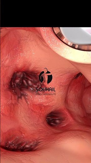 Diverticulosis & Diverticulitis