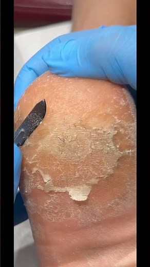 Heel Callus Removal