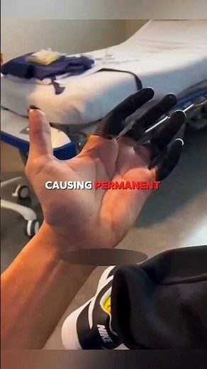 Why Frostbite Turns Skin BLACK ❄️💀