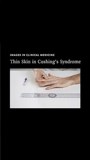 Images in Clinical Medicine: Thin Skin in Cushing’s Syndrome