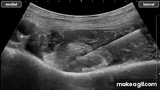 Ultrasound-Guided PENG Block | Anatomy, Sonoanatomy & Technique on Make a GIF