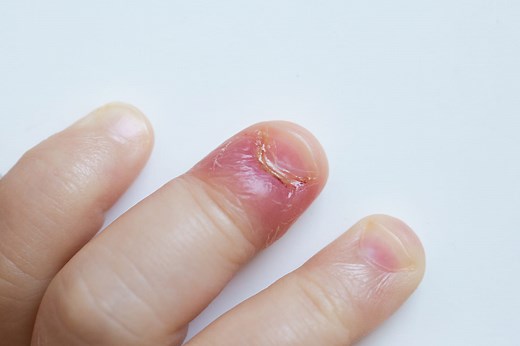 Panaris : à quoi ça ressemble, conseils de dermatologue