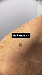 Are you a health professional and want to learn dermoscopy? 🔍 I recommend the certificate dermoscopy courses by @healthcert Use discount code DRJOHN for a 15% discount. Are you from the U.S. 🇺🇸 and want to learn the basics of skin cancer medicine and how to introduce it into your practice? I recommend the Skin Cancer Medicine Accelerator Program by MoleScan. Use discount code DRJOHNUS See links in bio for more information. #dermoscopy #skincancer #skincancerdoctor #buderim #sunshinecoast #mel