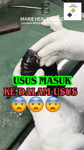 Marie Healthcare on Instagram: "🚨 USUS MASUK KE DALAM USUS = DARURAT 🚨 Ini disebut intususepsi. Usus “menyusup” ke usus lain → aliran darah terhenti → jaringan mati (nekrosis) seperti di video ini. Telat ditangani = operasi darurat & risiko nyawa. Sering terjadi pada: • Bayi & anak kecil • Tapi dewasa juga bisa kena, biasanya karena tumor, polip, atau gangguan usus Jika ada gejala pencernaan berat, jangan tunggu. DM kami, kami bantu rujukan cepat & penanganan terbaik, termasuk opsi rumah sakit