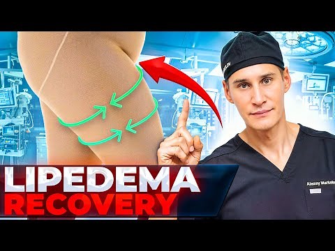 Expert Tips for LIPEDEMA Surgery Recovery