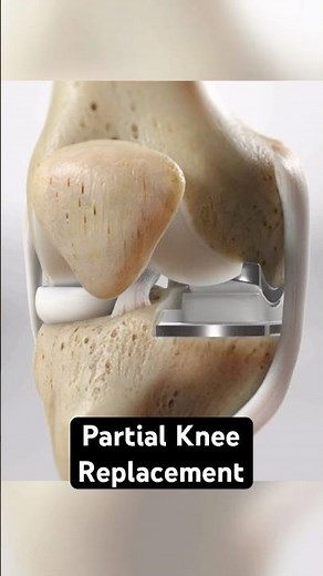 Partial Knee Replacement (3D Animation)