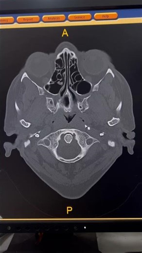 Temporal Bone CT | Mastoiditis or Cholesteatoma? 🤔 #shorts