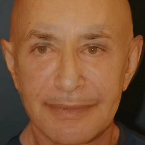 Male Facelift, Eyes, Lips