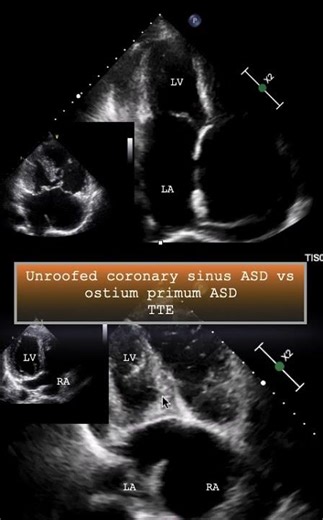 Unroofed coronary sinus ASD vs. ostium primum ASD/ TTE