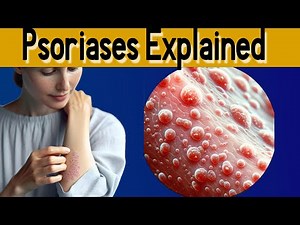 Psoriasis 101: explained under 3 minutes