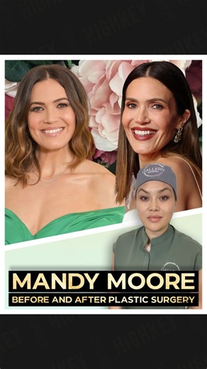 HighKey® Agency on Instagram: "Mandy Moore’s new appearance sparked headlines, and Dr. Wong breaks it down with nuance. A leaner face from weight loss plus eyelid rejuvenation could be the key factors in her brighter, more defined look. HighKey Agency supported this expert commentary, turning complex facial changes into clear, digestible insight. @ladyplasticsurgeon #socialmedia #smm #viral #meded"
