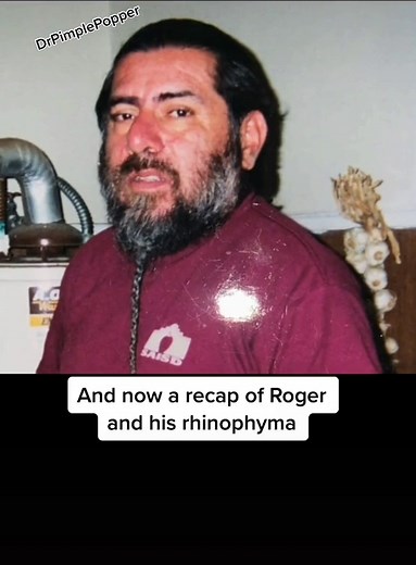 Part 1! Here’s a little ROGER Rhinophyma Recap! Watch my TikTok LIVE tonight when I see him for the first time since surgery!