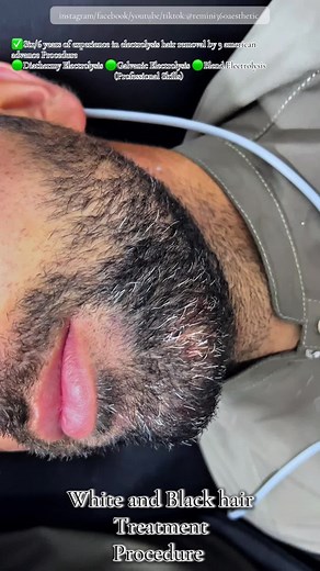 Permanent Hair Removal Treatment for All Hair Types
