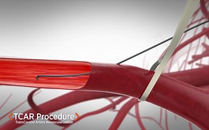 Silk Road Medical的ENROUTE® Transcarotid Neuroprotection TCAR系统