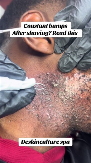 Tips to Prevent Bumps After Shaving