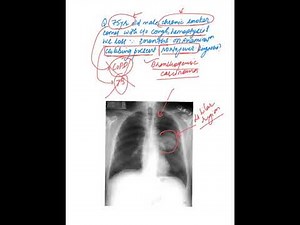 Approach to nail clubbing