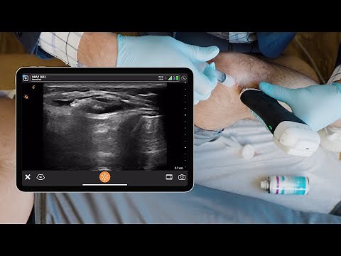 Infrapatellar Saphenous Nerve Block