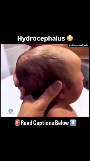 Hydrocephalus Explained | Causes, Signs & Treatment 🧠⚠️