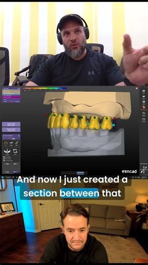 10 Minute Immediate Denture Design in Exocad