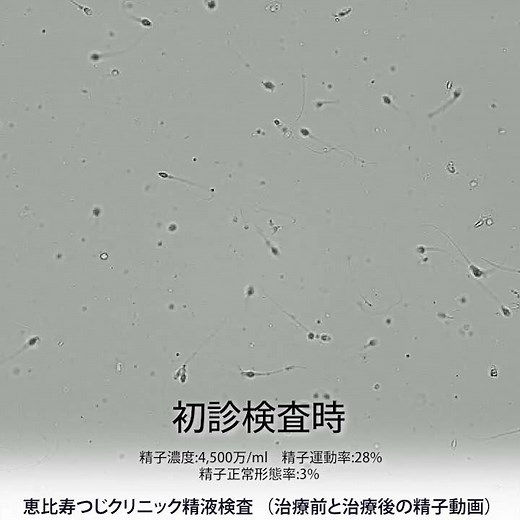 「精索静脈瘤手術後すぐ改善する例」（恵比寿つじクリニック精液所見比較動画 No.34）
