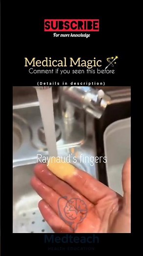 “⚠️ Why Your Fingers Turn White or Blue in Cold? | Raynaud’s Phenomenon Explained🩸” #raynaudsdisease