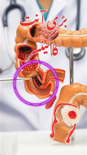 Colorectal Cancer Symptoms | Early Signs of Colon Cancer | Blood in Stool meaning | Stomach Cancer