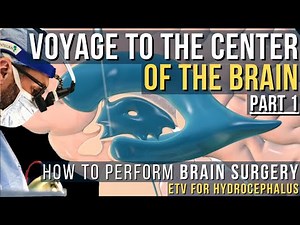 See the Brain From the INSIDE out | How to Perform Brain Surgery for Hydrocephalus