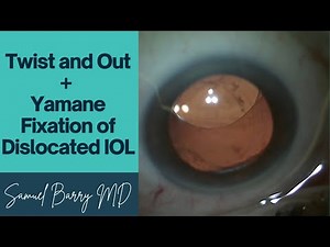 Twist and Out Technique for IOLs + Yamane Intrascleral Haptic Fixation with ZA9003