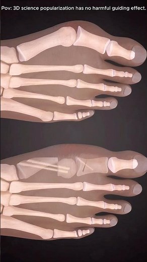 Minimally Invasive Hallux Valgus (Bunion) Surgery#halluxvalgus #bunionsurgery #bunioncorrection