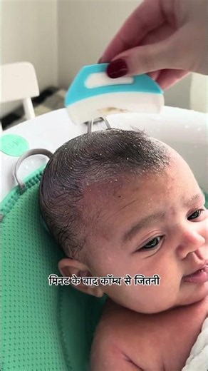 Baby’s Head Has White or Yellow Flakes? | Cradle Cap Explained | Baby Scalp Care