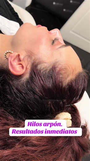 Resultados Increíbles con Hilos PDO para Belleza