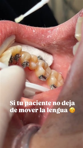 Aroha by Lina Quintero Ortodoncista | Habrá algo más contraproducente que decirle a un paciente “porfavor no muevas la lengua” o “no vayas a tocar con la lengua”? 😂, bueno, esto... | Instagram