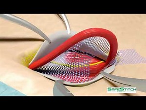 Inguinal hernia surgery animation