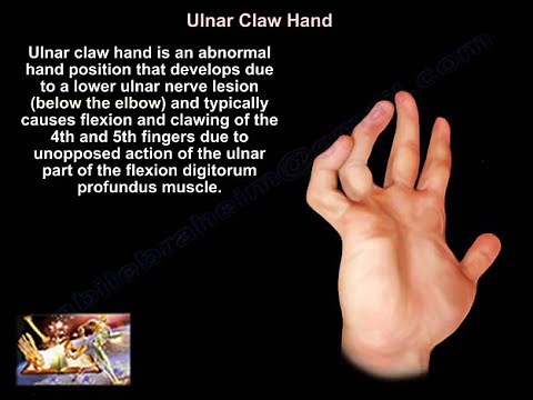 Claw Hand and Ulnar Claw Hand - Everything You Need To Know - Dr. Nabil Ebraheim
