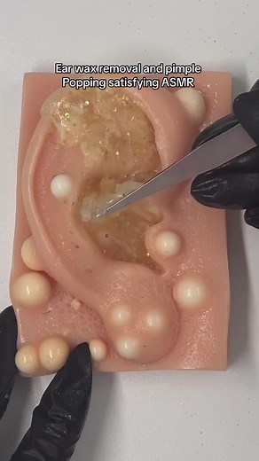 Ear Wax Removal and Pimple Popping ASMR