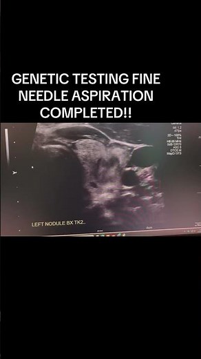 Ultrasound Guidance Fine Needle Aspiration