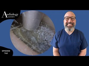 HARD AS STONE EAR WAX PLUG REMOVAL - EP743
