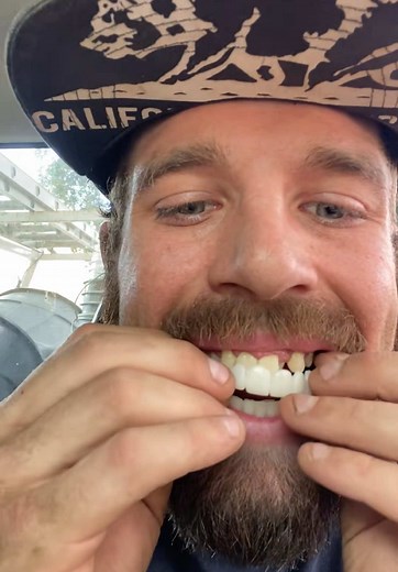 Snap-On Veneers: A Realistic Solution for Great Smiles