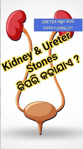 How to remove ureter stones ? URSL step by step // Dr Sunil Kumar Das //UROLOGY #stone #kidney #urs