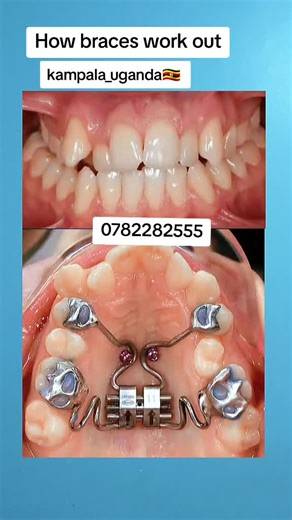 #Teeth alignment with braces #for an amazing smile#kampala_uganda🇺🇬🇺🇬