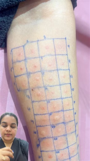 Dr.Chandni Engoor | ENT & Allergy Specialist in Cochin on Instagram: "സ്കിന്നിൽ വരുന്ന അലർജി ഭക്ഷണം കൊണ്ടു മാത്രമാവണമെന്നില്ല. ചൊറിച്ചിൽ, റാഷസ്, വീണ്ടും വീണ്ടും തിരിച്ചു വരുന്ന സ്കിൻ പ്രശ്നങ്ങൾ 👉 പല കാരണങ്ങൾ കൊണ്ടാവാം. അതുകൊണ്ടാണ് Immediate allergy കണ്ടെത്താൻ Skin Prick Test Delayed allergy കണ്ടെത്താൻ Patch Test 👉 Guess ചെയ്യാതെ 👉 ശരിയായ ടെസ്റ്റ് ചെയ്താൽ മാത്രം clarity. #allergydoctorkochi #allergydoctor #allergytesting #skinpricktest #patchtest"