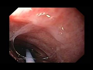 Inadvertent Intubation of Airway Around Endo Triachial Tube • Video • MEDtube.net