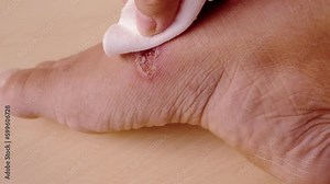 closeup of weeping wound, trophic ulcer on female leg, wound exudate prevents healing ulcers by destroying growth factors, concept of self-treatment at home, sanitation pathogenic microflora