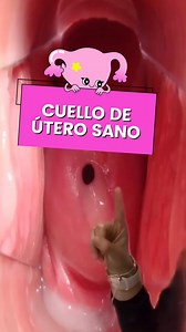 Así se ve un cuello de útero sano. ✅ Pero a veces no es lo que parece, por ello debes realizarte periódicamente papanicolau y colposcopía, para asegurarnos de que estás sana. 💜 El papanicolau puede salir bien y con nada visible, pero a la hora de realizar la colposcopia, ¡salen las lesiones! Por eso recomiendo que siempre se hagan juntas. 🙌🏼 ¿ya te hiciste tus chequeos de este año? ¡Faltan pocos meses para que inicie el 2025! Tengo promos, mándame dm. 💜 Dra. Verónica Noemí Reyes Santillán CP