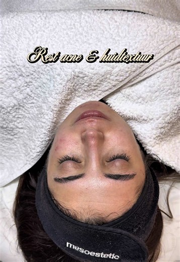 Behandelvideo mesopeel axion pen 🏹 Dit is een kuurbehandeling, waarbij de klant over 2 weken weer terugkomt voor haar tweede behandeling. Ik neem jullie mee in haar proces en kan niet wachten de resultaten met jullie te delen. #studenthuidtherapie #facial #huidtherapie